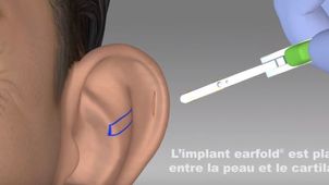 Les implants Earfold