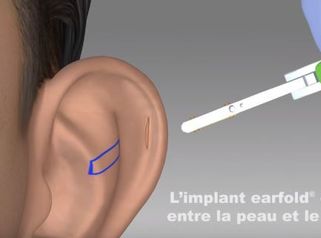 Implants Earfold