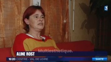 La reconstruction mammaire par DIEP - France 3