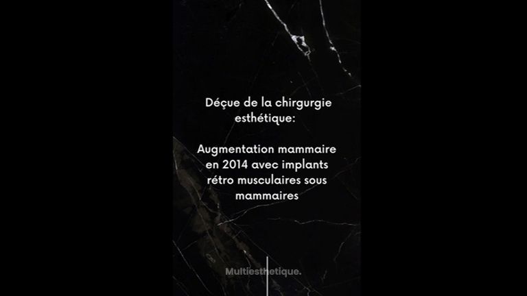 Augmentation mammaire - Dr Paul Seknadje