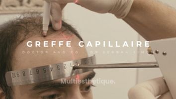 Greffe de cheveux - Doctor and Co PARIS