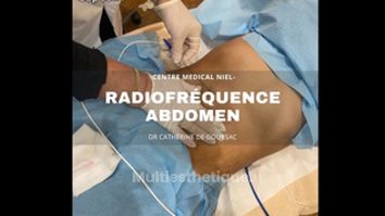 Radiofréquence - Dr Catherine de Goursac