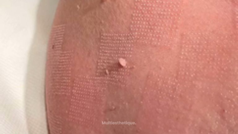 Traitement cicatrice - Dr Juan Carlos Rivera