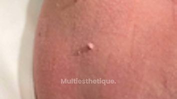 Traitement cicatrice - Dr Juan Carlos Rivera