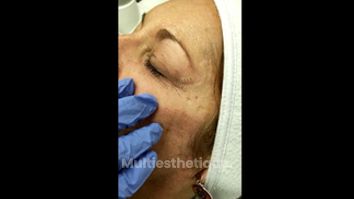 Blépharoplastie - Dr Marie Levisse