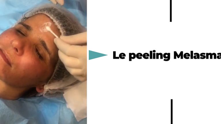 Peeling Melasma - Dr Catherine De Goursac 