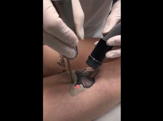 Détatouage laser d'un papillon sur une jambe d’une patiente au Cabinet du Dr Didier Dubois à Angers