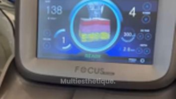 Radiofréquence microneedlée Dr De Goursac