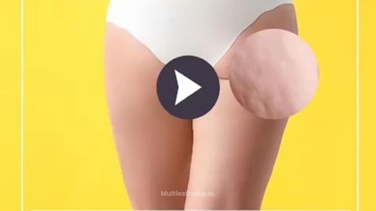 Traitement de la cellulite par attiva - Dr Catherine de Goursac