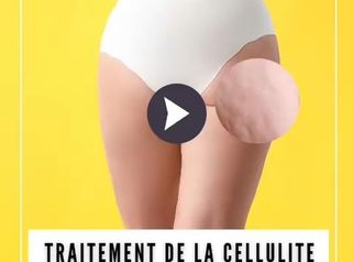 Traitement de la cellulite par attiva - Dr Catherine de Goursac