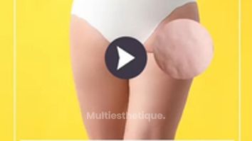Traitement de la cellulite par attiva - Dr Catherine de Goursac