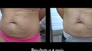 Prise en charge des vergetures Prise en charge des vergetures
