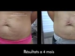 Prise en charge des vergetures et du relâchement cutané