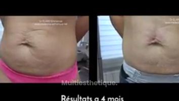 Prise en charge des vergetures et du relâchement cutané