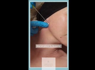 Fils tenseurs - Dr Marie Levisse - méDiKal esthétique