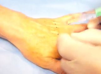 Le rajeunissement des mains par acide hyaluronique