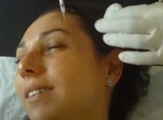 wrinkles injection sedation with MEOPA - kalinox