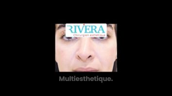 Rhinoplastie - Dr Juan Carlos Rivera