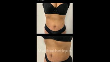 Abdominoplastie - Dr Paul Seknadje