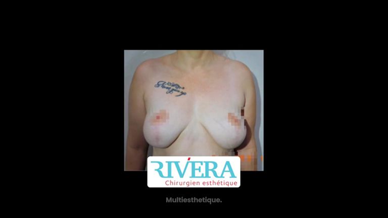 Mastopexie - Dr Juan Carlos Rivera