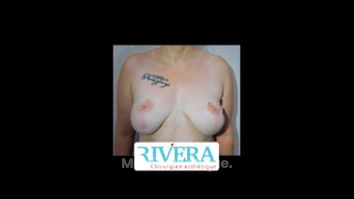 Mastopexie - Dr Juan Carlos Rivera