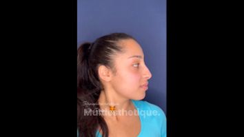 Rhinoplastie - Dr Pierre-Manuel Renard