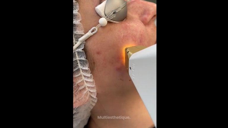 Couperose - Dr Mahboubeh Charlot