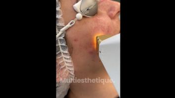 Couperose - Dr Mahboubeh Charlot