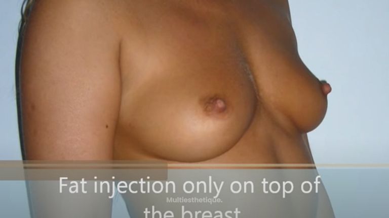 Breast-lipofilling par Docteur Laurent Benadiba