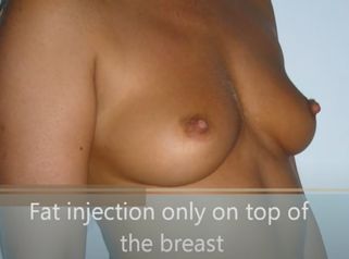 Breast-lipofilling par Docteur Laurent Benadiba