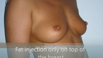 Breast-lipofilling par Docteur Laurent Benadiba