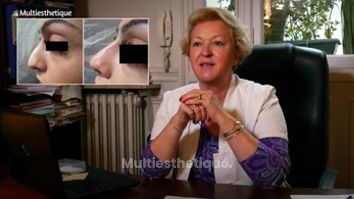 Rhinoplastie médicale : retoucher son nez sans bistouri