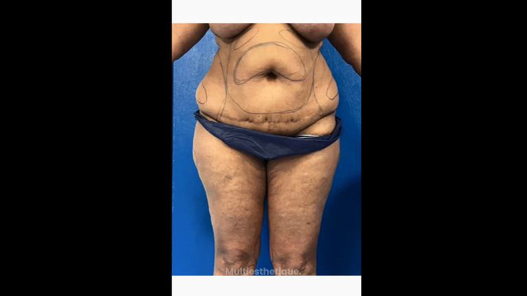 Liposuccion - Dr Behzad Badie Modiri