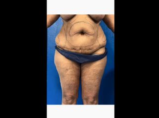 Liposuccion - Dr Behzad Badie Modiri