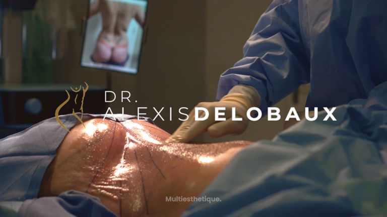 Liposuccion - Dr Alexis Delobaux