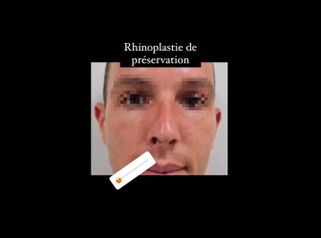Rhinoplastie - Dr Juan Carlos Rivera