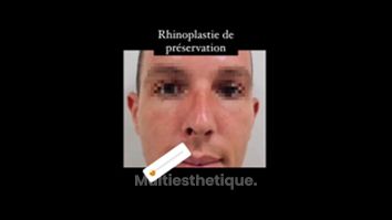 Rhinoplastie - Dr Juan Carlos Rivera