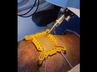 Implants capillaires - Dr Gilles Le Traon