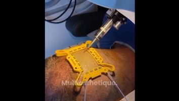 Implants capillaires - Dr Gilles Le Traon