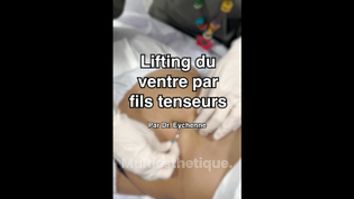 Lifting du ventre par fils tenseurs - Dr Catherine Eychenne - Esthetic Medicare Center