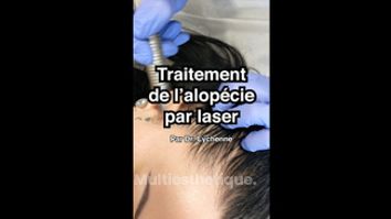 Traitement de l'alopécie par laser - Dr Catherine Eychenne - Esthetic Medicare Center