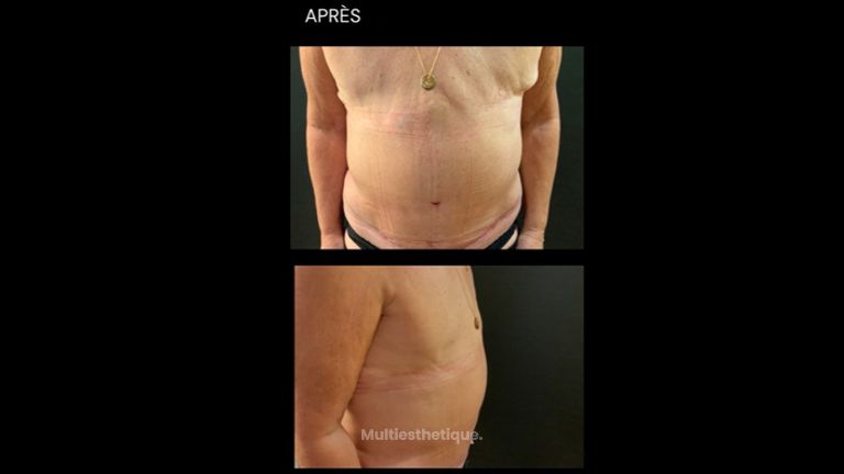 Abdominoplastie - Dr Paul Seknadje