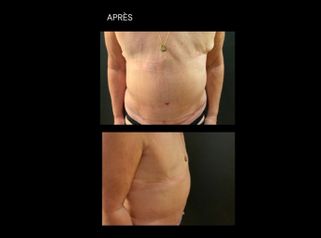Abdominoplastie - Dr Paul Seknadje