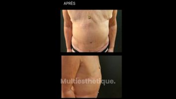 Abdominoplastie - Dr Paul Seknadje