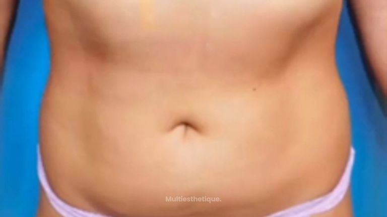 Lipo