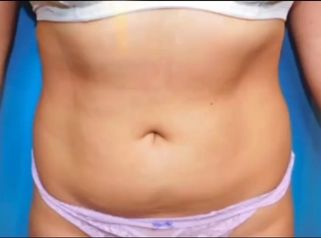 Lipo