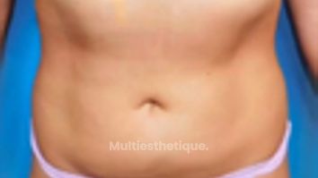 Lipo