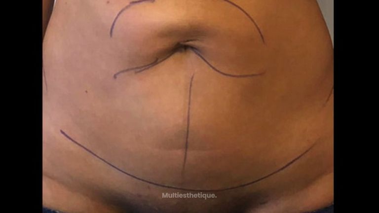 Renuvion - Dr Laurent Benadiba M.D
