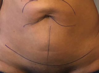Renuvion - Dr Laurent Benadiba M.D