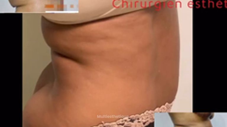 Abdominoplastie - Dr Juan Carlos Rivera